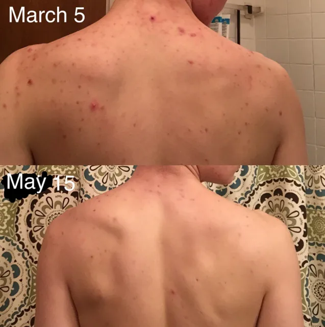 James's back on March 5 and on May 15